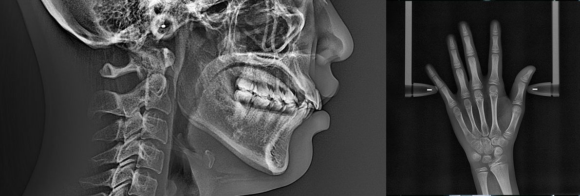 측면 두부 X-ray 사진과 손(성장판) X-ray 사진