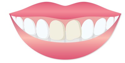 앞니 사이와 잇몸 경계에 착색이 남은 웃는 입 일러스트